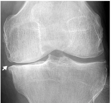 Figure 1-10 : Radiographie antéropostérieure d’un genou qui démontre une réduction de l’espace  articulaire, de la sclérose et la formation d’un ostéophyte (flèche blanche), tous des  caractéristiques de l’arthrose (Jacobson, Girish, Jiang, &amp; Sabb, 200