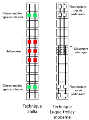 Figure 2-15 : Schématisation de la technique Shilla et Luque trolley moderne 