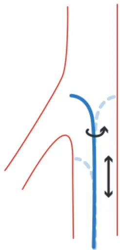 Figure 1.5. Mouvements que l’interventionniste peut transmettre : translation et rotation du guide ou du cath´ eter.