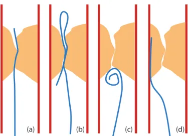 Figure 1.12. Difficult´ es de passage au travers d’une st´ enose. Le cas (a) montre un passage sans probl` eme, le cas (b) montre qu’une partie du guide parvient `a passer en cr´ eant un coude