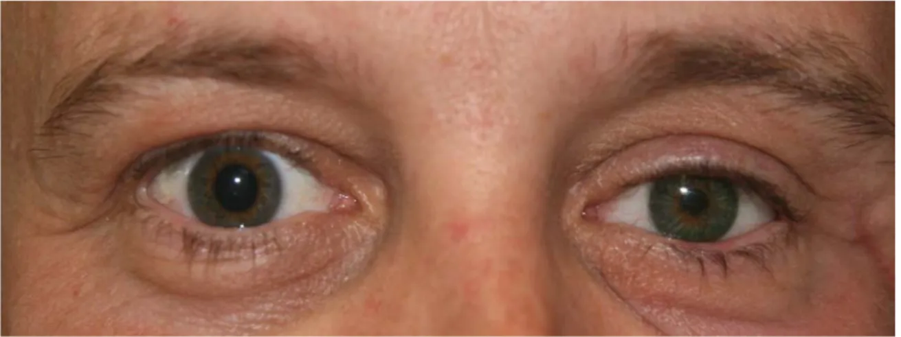Figure 1 : Un patient possède une prothèse oculaire au lieu de son œil gauche. La dissemblance  entre les deux pupilles est aisément notable