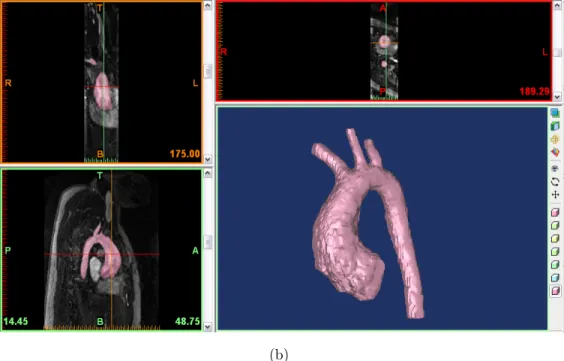 Figure 4.3 Processus et r´ esultats de segmentation sur Mimics. (a) premi` ere s´ election grossi` ere par seuillage et modification 3D