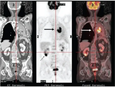 Figure 2.1 – Images TDM, TEP, TEP et TDM fusionnées d’un système hybride TEP-TDM (source : Pinilla et al