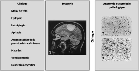 Figure 2.1 – Approche à plusieurs échelles du diagnostic d’une tumeur cérébrale. L’IRM circons- circons-crit la zone envahie (1) et guide le chirurgien dans le choix de la biopsie (2)