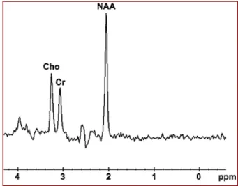 figure 5 : profil spectral en zone cérébrale normale. 