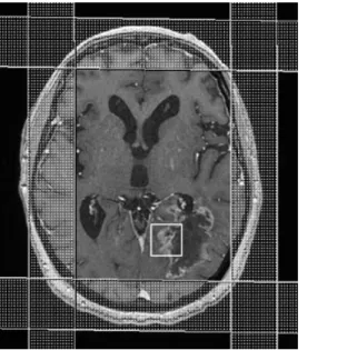 figure 6  : à gauche : positionnement du voxel dans la lésion, à droite, prof il spectral qui  montre une augmentation relative du pic de choline par rapport au pic de NAA qui diminue,  et surtout le large pic de lipides-lactate dans le cadre d’un gliome d
