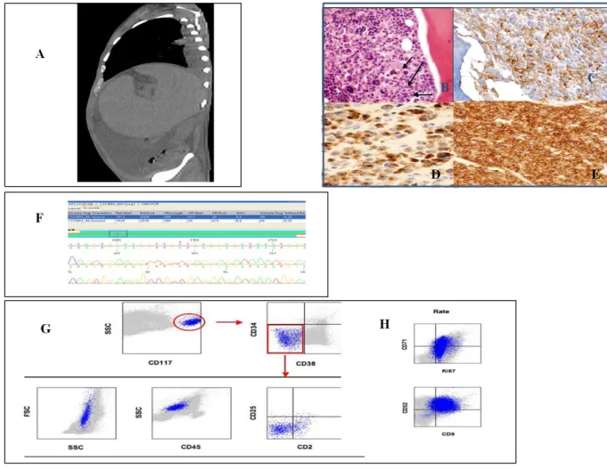 Figure  5.  Patient, Mr  L,  with  mast  cell  sarcoma  and,  c-Kit  Val560Gly  mutation;  hTERT 