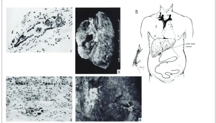 Figure  4: Expérience de pose de drain péritonéo-veineux sur la dissémination  métastatique des adénocarcinomes séreux ovariens