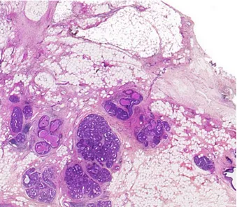 Figure 4 : lame d’histologie (carcinome intra- intra-canalaire in-situ – tissu mammaire 