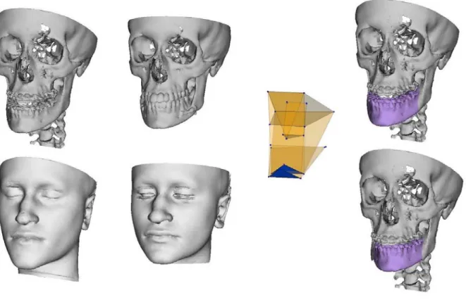 Figure 1 : clinical case of mandibular prognatism. Left, the patient skull and skin surface,  before and after the surgery