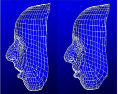 Figure 5. Simulation of soft tissue deformation resulting from mandible and maxilla reposition- reposition-ing 