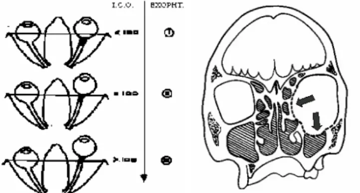 Fig. 1. (a) At the left; exophthalmia can be light (top), moderated (middle) or excessive (bot- (bot-tom)