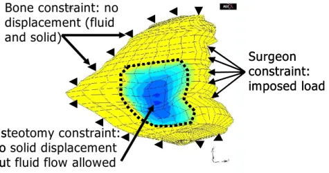 Fig. 3. Boundary conditions applied to the orbital mesh to simulate the decompression surgery 