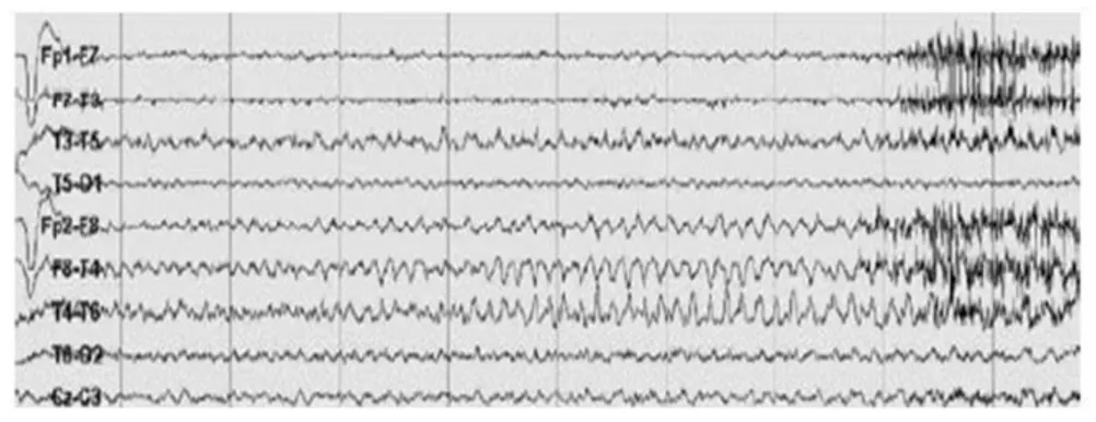 Figure  1-6 :  Décharges  thêta  7  Hz  temporales  droites  chez  un  patient  avec  épilepsie  partielle  temporale