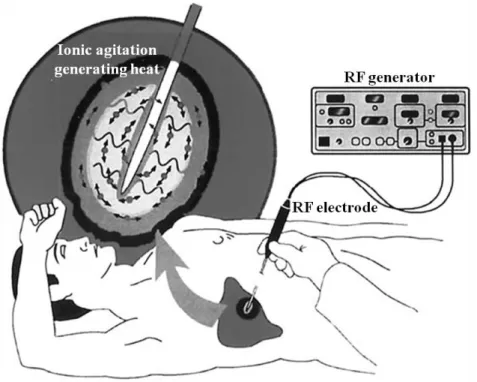 Figure 2.2: The image presents the percutaneous radiofrequency ablation (RFA) procedure in the  liver (image source from [35])