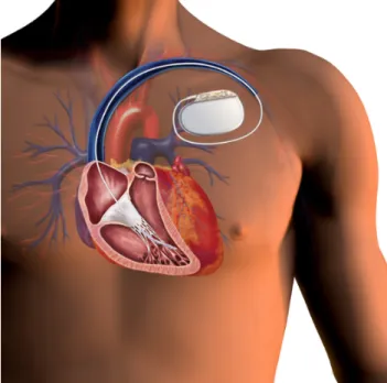 Figure 1.1 DECI implanté dans la région pectorale (source [16])