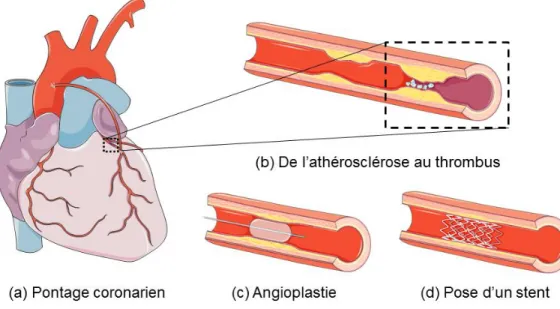 Figure 1-1 : Traitements de l’athérosclérose.  