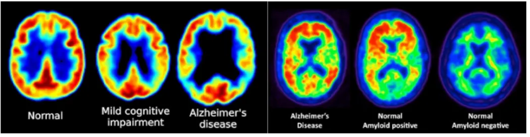 Figure 2.9 FDG-PET images showing reduced glucose metabolism in temporal and parietal regions in patients with MCI and Alzheimer’s disease (left) 