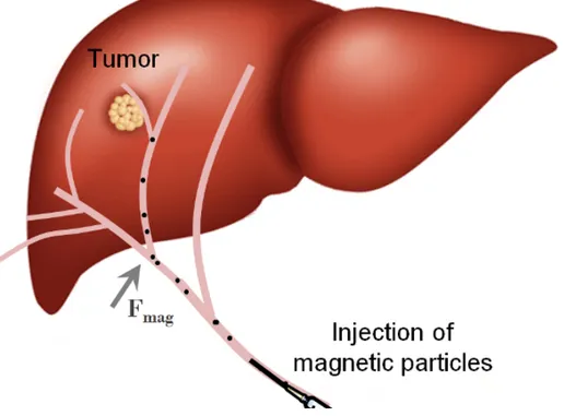 Figure 2-1: Sketch of MRI targeting of a tumor site by applying a magnetic force on volumes  loaded with therapeutic agents and magnetic particles