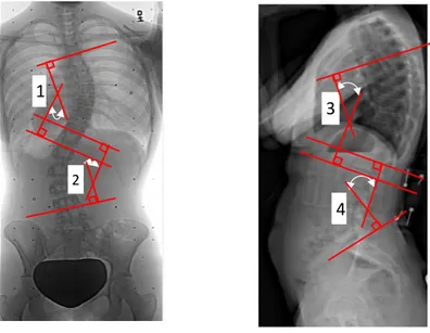 Figure 1.9:  Traditional  method  in  measurement  of the 1) Thoraco- lumbar curve Cobb’s  angle,  2) kyphosis and 3) lordosis in a scoliotic subject (Saint- Justine University Hospital database)