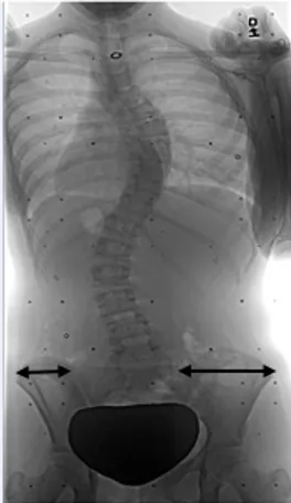 Figure  1.11:  Pelvic  rotation  in  the  transverse  plane  presented  as  unequal  ilium  width  on  the  antero-posterior radiograph (Saint-Justine University Hospital database)