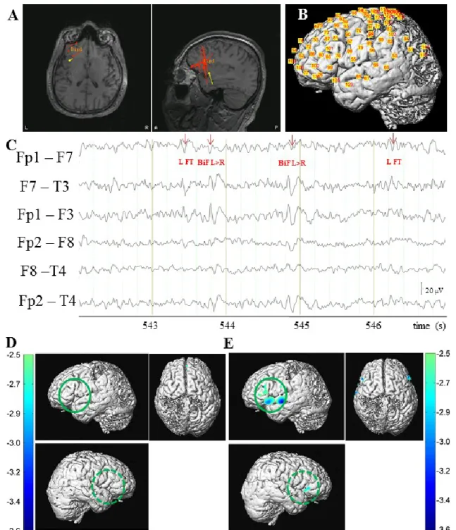 Figure 4.1 Patient #36. (A) MEG dipole localization of epileptic spikes revealing a cluster of sources in the  L inferior frontal gyrus and L anterior insula