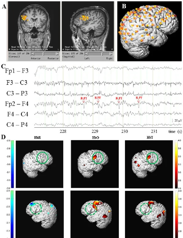 Figure 4.2 Patient #7. (A) MEG dipole localization of epileptic spikes revealing a cluster of sources in the  right inferior frontal gyrus