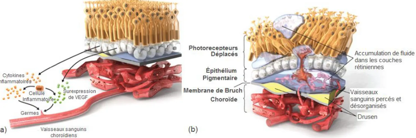 Figure 1-7: Formation de la néovascularisation : (a) réaction inflammatoire produisant les VEGF  et (b) traversée des néovaissaux à travers la membrane de Bruch (The Angiogenesis Foundation, 