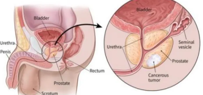 Figure  2.1 :  Human  reproductive  anatomy  with  closeup  view  of  prostate  and  prostate  cancer