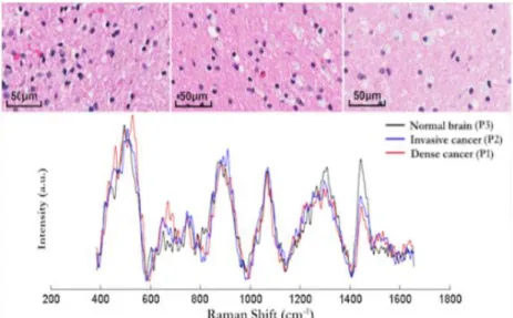 Figure 2.4  (Top) Histopathology images of 3 brain tissue biopsy samples (left: dense cancer  tissue, middle: invasive cancer, right: normal tissue) corresponding to locations where RS  measurements were made