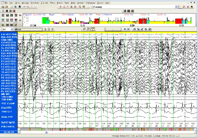 Figure 3-2: Visualisation d’un segment d’enregistrement PSG dans le logiciel Harmonie 