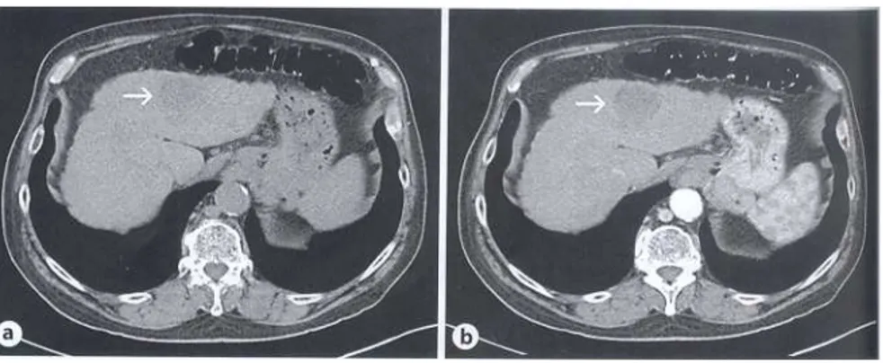 Figure 1. 6: Image CT d’un CHC hypo vasculaire dans un foie cirrhotique. Le CHC est une lésion hypodense  ronde identifiée par une flèche: (a) au temps artériel et (b) au temps veineux [247]