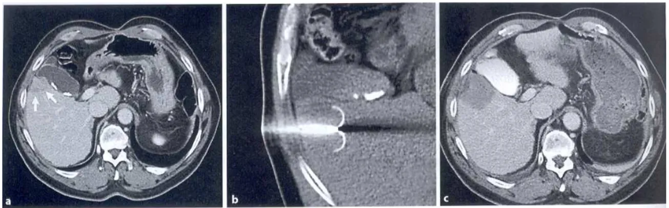 Figure  1.  7:  Images  CT  d’une  ablation  par  RF  d’un  CHC:  (a)  lésion  hypo-vasculaire  située  sous  la  vésicule  biliaire, (b) aiguille RF de 35 mm placée dans la tumeur, (c) zone hypo-dense après le traitement recouvrant  entièrement la lésion 