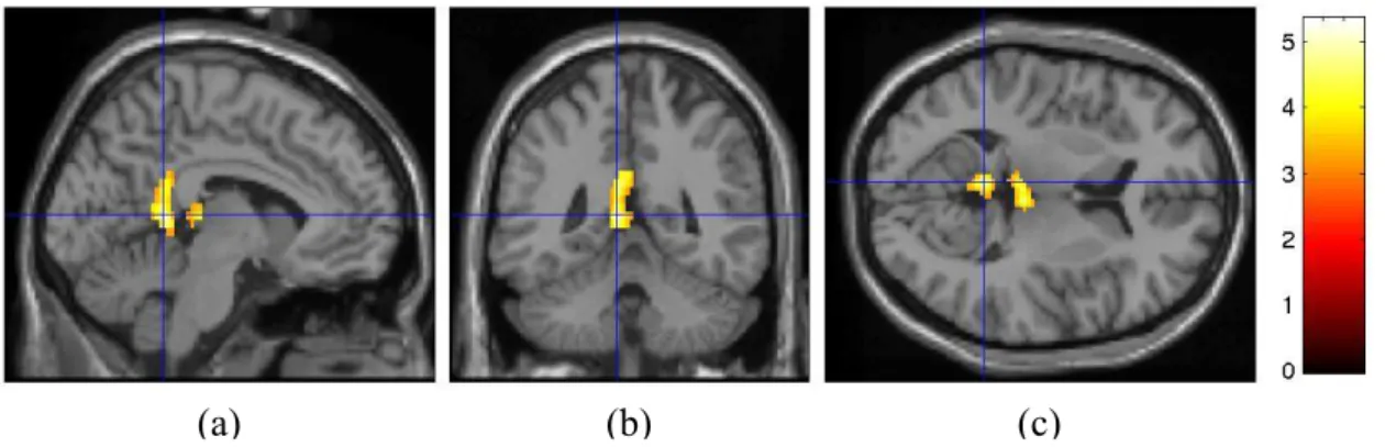 Figure I.2.3 : exemples d’images de l’activation cérébrale par IRMf [Ruff et al. '03]