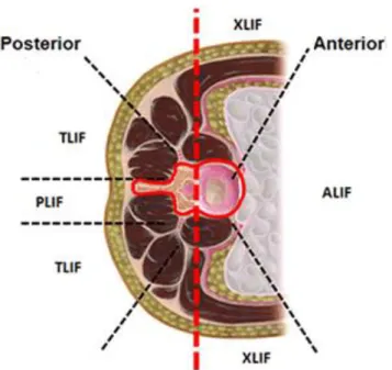 Figure  2-9  Common  surgical  fusion  approaches  (Image  taken  and  modified  from  https://pbrainmd.wordpress.com/2015/10/11/lumbar-interbody-fusion/ on 2018-03-13)  