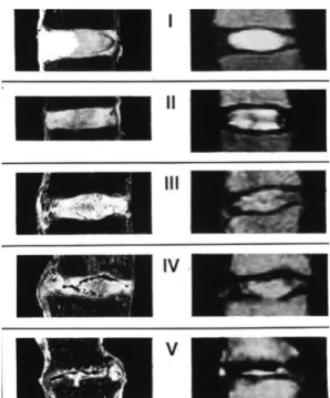 Figure  1-4:  Avec  l’augmentation  de  la  dégénérescence,  la  limite  entre  le  nucleus  et  l’annulus  devient de moins en moins nette : le disque perd son contenu en eau et de sa hauteur
