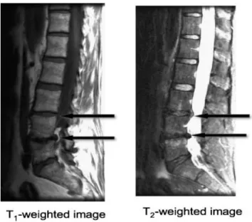 Figure 1-7: Les images IRM pondérées en T1 et en T2 montrent les variations du signal IRM, les  flèches pointes les pathologies (Majumdar, Thomasson et al