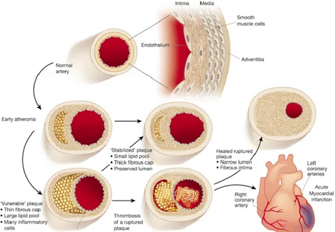 Figure 2-2 : Développement de l’athérosclérose 9 2.1.2  Facteurs de risque 