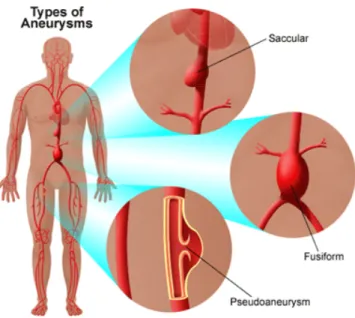 Figure  1.2 Different types of aneurysm (Yale Medical Group, 2010)  1.2 Causes, Developments and Risk Factors 