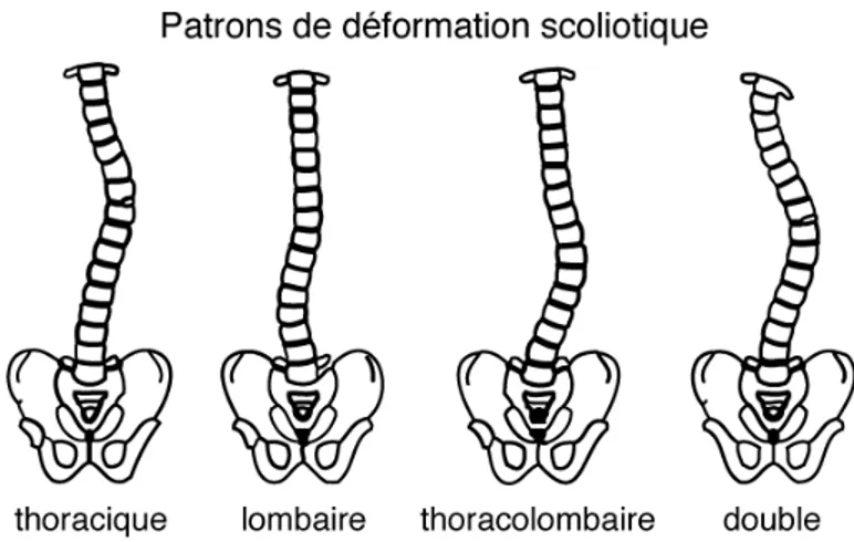 Figure 1.8 : Représentation schématique des patrons de déformation scoliotiques (image adaptée  de  [92]) 