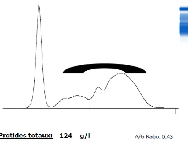 Figure 20 : Tracé d’électrophorèse d’une vache, atteinte de bronchopneumonie 