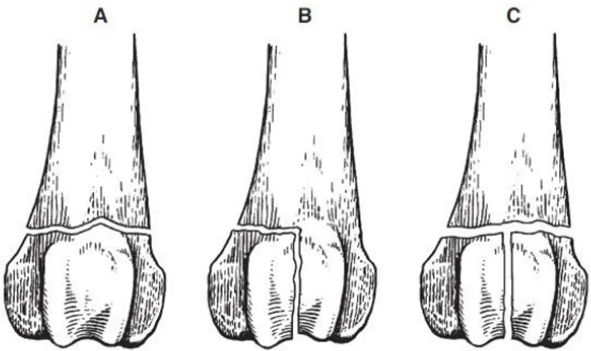 Figure n° 13 : Types de fractures proximale et distale d’un os long (A : extra-articulaire, B : 