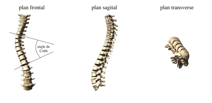 Figure 1.10: Déformation 3D de la scoliose idiopathique adolescente angle de 