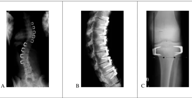 Figure 1.12: Implants de type agrafes. A: Betz et al. [109]. B: Wall et al. [110]. C: Gorman et  al