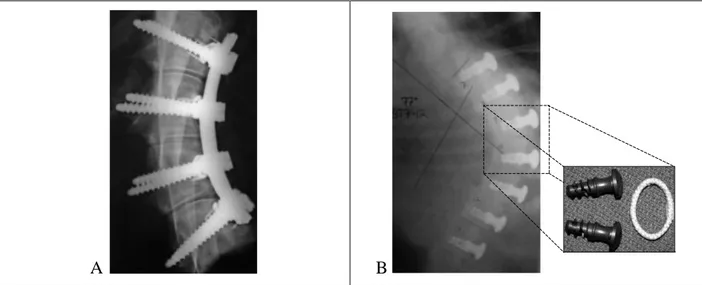 Figure 1.13: Implants de type « ancre-ligament ». A: Newton et al. [113]. B: Braun et al