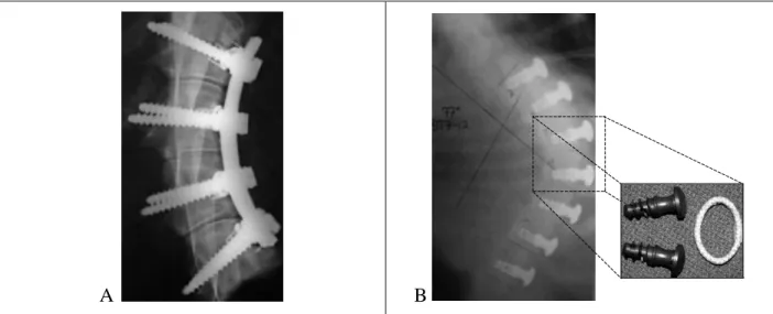 Figure 1.13: Implants de type « ancre-ligament ». A: Newton et al. [113]. B: Braun et al