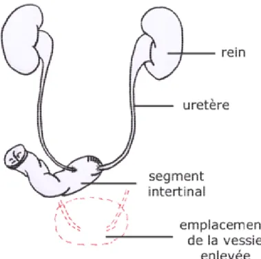 Figure N° II-8 : Dérivation des urines à la peau selon la technique de Bricker.  Un segment d'intestin est interposé entre les uretères et la peau [Bricker; 1950].