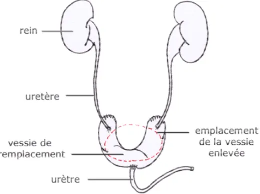 Figure N° II-9: Un segment d'intestin est utilisé pour modeler une poche qui sert de réservoir  entre les uretères et l'urètre [Sarosdy &amp; Lamm; 1989].