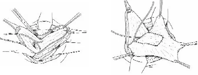 Figure N° II-10: Clam-cystoplastie: ouverture transversale de la vessie au niveau de sa partie  mobile libérée .