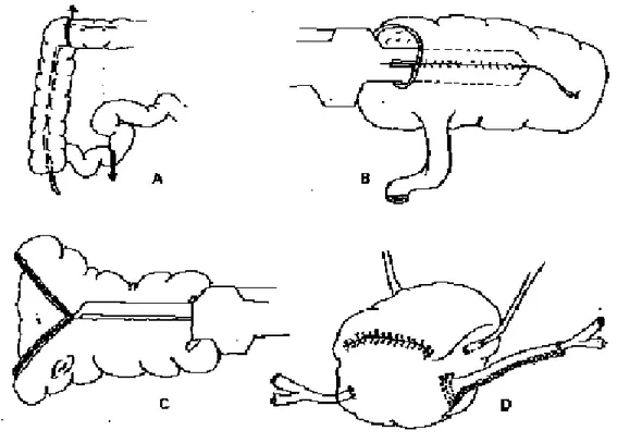 Figure  N°  III-2:  Description  schématique  de  la  technique  opératoire  de  la  poche  de  Miami [Bladou et al ; 1996].